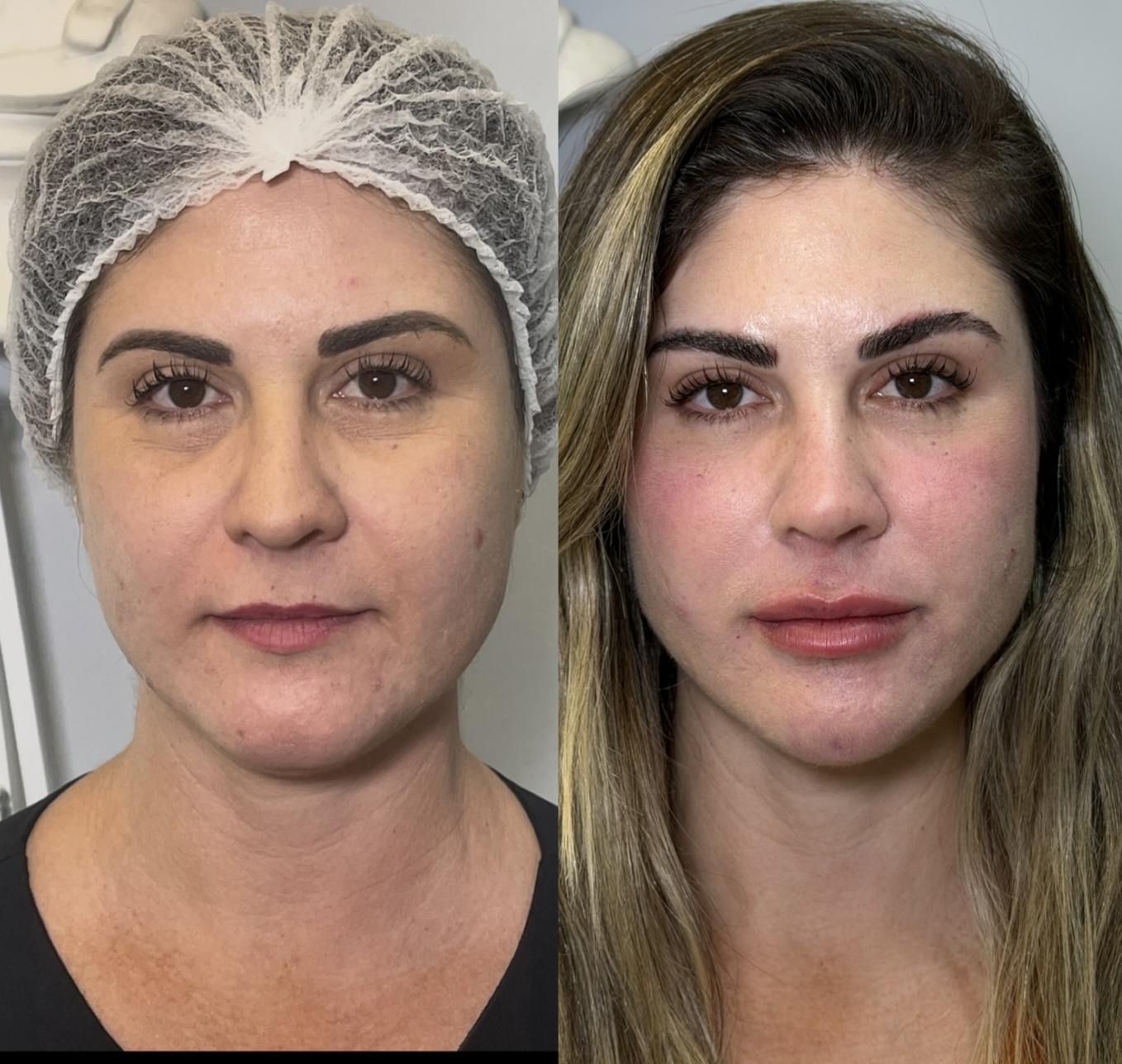 Tratamento facial avançado