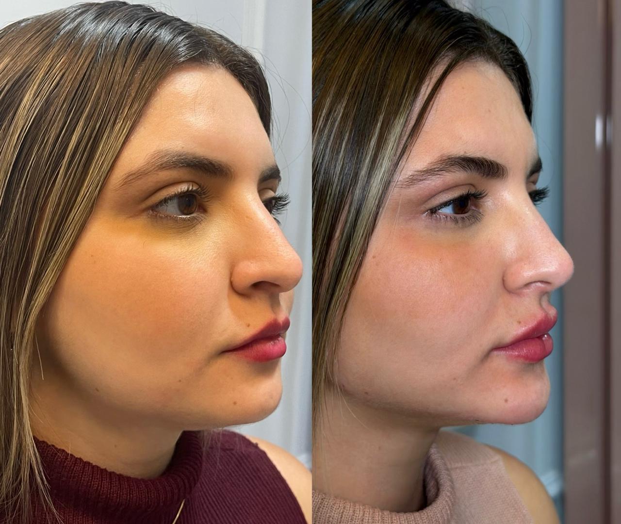 Preenchimento facial