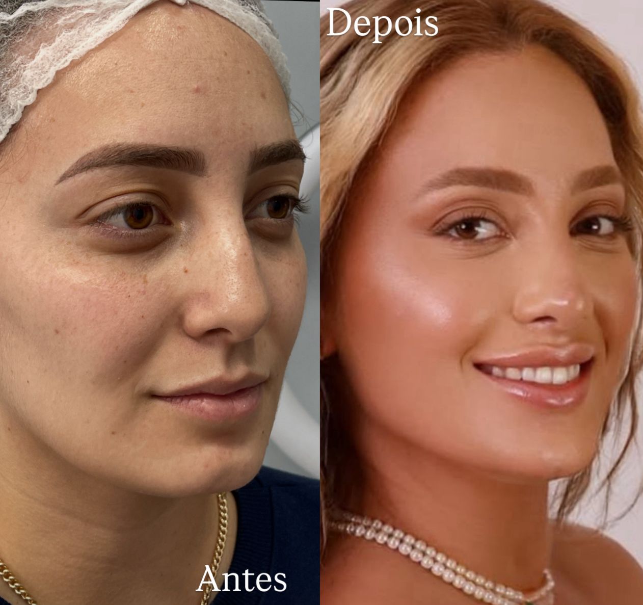 Preenchimento facial