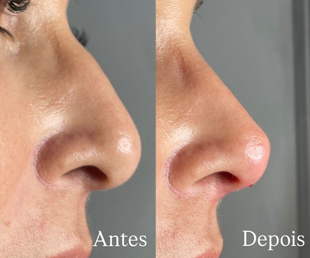 Rinomodelação antes e depois